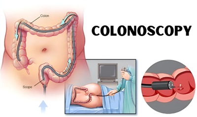 اسعار منظار القولون فى مصر
