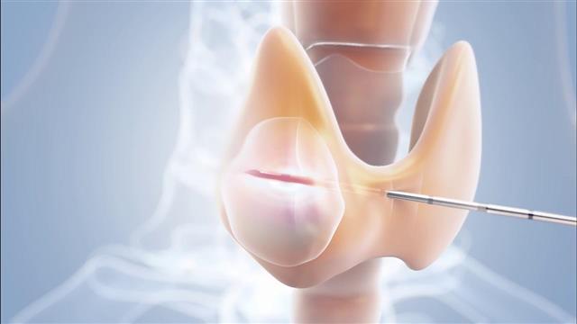 علاج الغده باليود: حلول فعالة واسعار مميزة في موقع VuDoctor